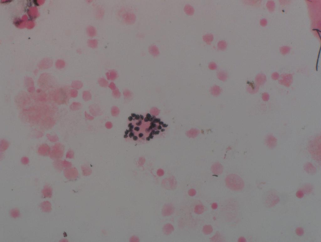 Biopsie/Zytologie 08/2015: Pneumocystis jirovecii- Pneumonie unter dem Bild einer teilweise