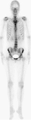 Knochenszintigrafie bei Osteomyelitis Vorzüge Hohe Sensitivität: Ein normaler Befund schließt eine OM aus GK-Scanin einer Sitzung (Detektionvon