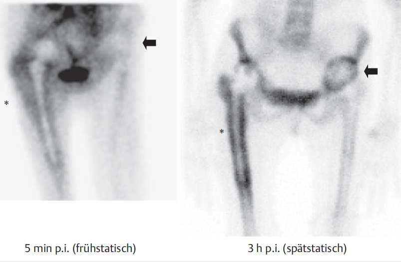 Positive 3-Phasen Knochenszintigrafie bei TEP Septische Lockerung Gesteigerte Anreicherung in Phase 1, 2 Gesteigerte periprothetische Anreicherung in Phase III Aseptische Lockerung Keine gesteigerte