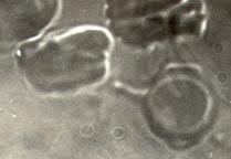 Manchmal trennen sich die Körner ab und fliessen ins Plasma hinaus (Bild 3). In einem Versuch ist die Entwicklung der Körner im eigenen Serum des Patienten während fünf Monate verfolgt.