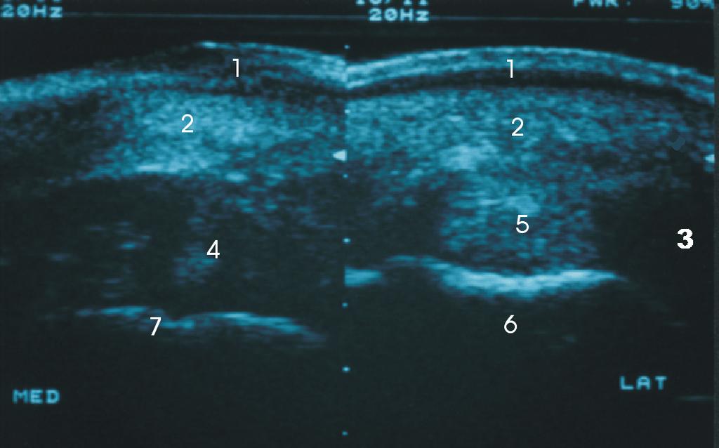 Dorsomedial (pathologisch) Dorsolateral (physiologisch) Abb. 47: Transversale Ansicht bei dorsomedialem (links) und dorsolateralem (rechts) Zugang.