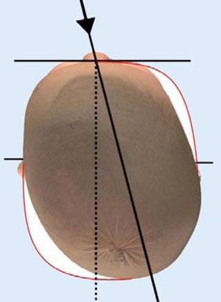 Abb. 7 8 Windschiefe Kopfform. Ausgeprägte Schädelbasisasymmetrie, meist assoziiert mit einem Tortikollis Abb.