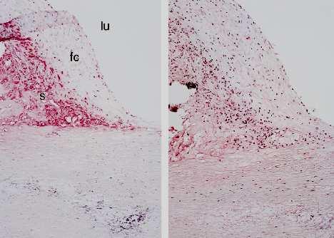 Anreicherung von ACE-Protein in Schaumzellen in der Schulterregion der fibrösen Kappe Lumen x100 fibröse Kappe Schulterregion Schaumzellen ACE-Protein