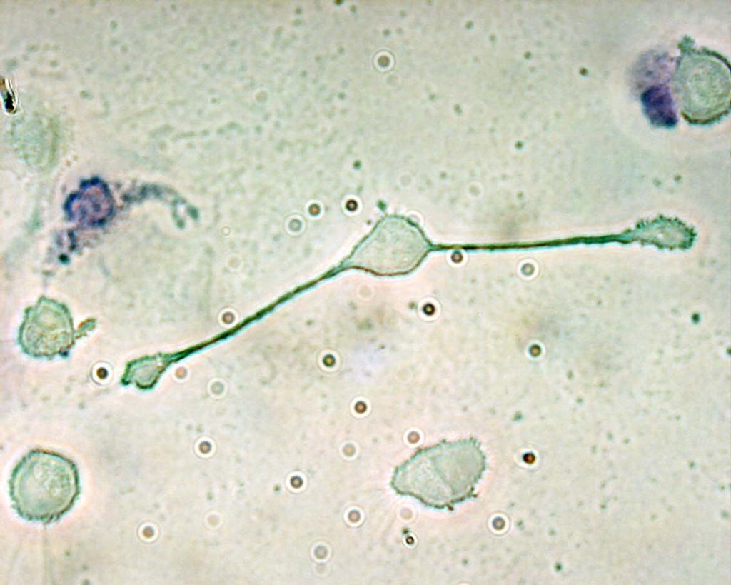 Alveoläre Makrophagen (Fresszellen) und