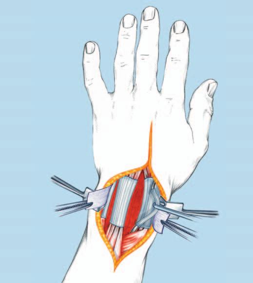 Das dritte dorsale Kompartiment eröffnen und den langen Daumenstreckmuskel (EPL) nach radial verlagern.