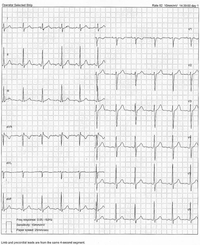 18 Abbildung 3: Ausschnitt aus einem H2-Holter Langzeit EKG von Proband 7, aufgezeichnet um 14:39 Uhr mit einer Papierlaufgeschwindigkeit