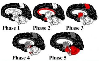 Amyloid-beta lagert sich in einer festen Reihenfolge in bestimmten Bereichen des Gehirns ab, zuerst im Neocortex (schwarz), dann im Allocortex (Phase 2, rot).