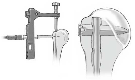 Abbildung 14 Einbringen der Verschlussschraube. Die Verschlussschraube schützt das Innengewinde des Nagels vor Gewebeeinwuchs und erleichtert die spätere Implantatentfernung.