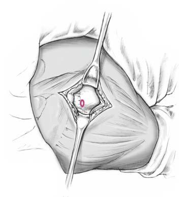 In bestimmten Fällen ist es erforderlich, nach einer geschlossenen Reposition den Humeruskopf temporär mit einem Raspatorium oder Bohrdraht zu fixieren.