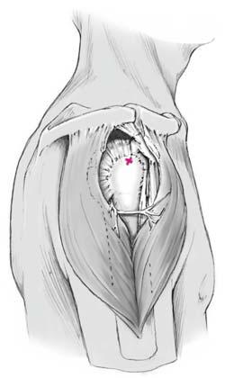 Anschließend anteriore Inzision im Akromionbereich sowie Spaltung des Musculus deltoideus und der Rotatorenmanschette (a, b), in der Regel jeweils durch Stichinzision.