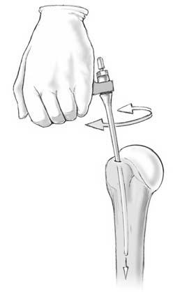 Abbildung 7 Einbringen des Nagels. Der Nageldurchmesser kann mit Hilfe der spezifischen Messlehre und des Bildwandlers bestimmt werden. Montage des gewählten Nagels auf den Zielbügel.