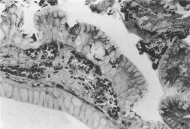 pylori wird von Marshall et al [7] die Entnahme von mehreren Biopsien von der großen Kurvatur des Magens in 5 cm Entfernung vom Pylorus empfohlen.