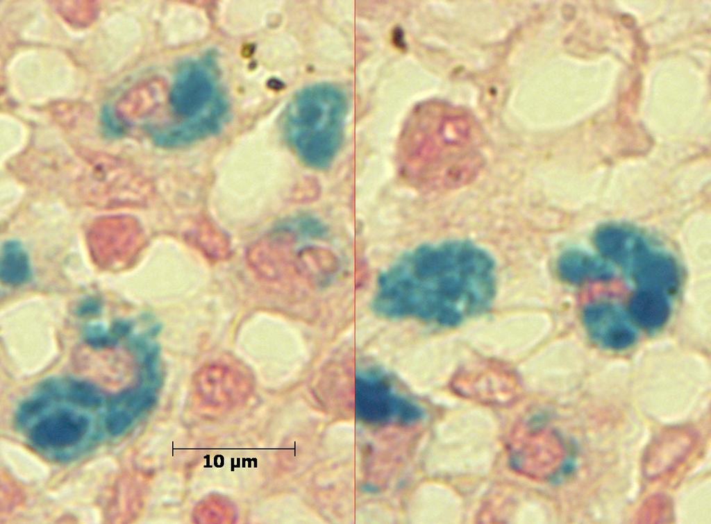 11 Makrophage Mensch, MGG-Färbung Beim Eisennachweis (histologischer Schnitt) sind die