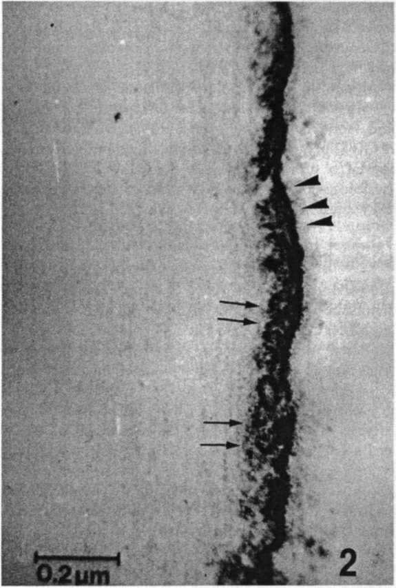 solche, die über 70 Jahre alt wurden. EKG-Veränderungen sind sehr selten. Aus diesen Angaben ist ersichtlich, daß das klinische Spektrum der BMD nicht so homogen ist wie das der DMD.