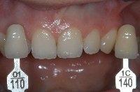 5 Ergebnisse 47 Abb. 9b: Das Ergebnis nach Abschluss der Bleichtherapie mit Odol-med3 (hier: der Zahn 23 hat nun die Vita-Classical-Zahnfarbe 1C). 5.