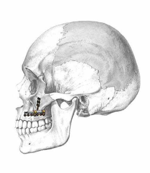 mit MODUS Implantatschrauben an den Knochen geschraubt (Bild 10).
