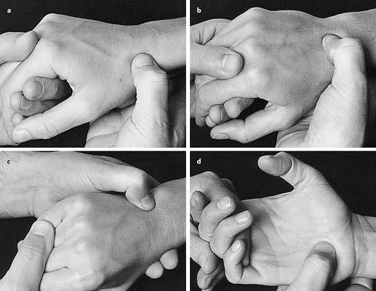 6.3 Handwurzelfrakturen 6 Abb. 6.10 a d Anatomische Lokalisation der wichtigsten Handwurzelknochen: Kahnbein (a), Mondbein (b), Hamatum (c), Triquetrum (d).