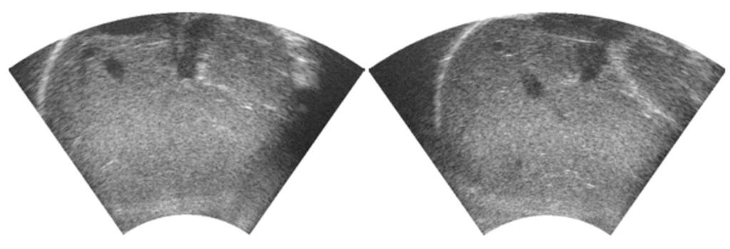 2 Datenaufnahme und Extraktion der Parameter Abbildung 2.2: Optisch unkorrelierte Ultraschall-B-Bilder der Leber Abbildung 2.