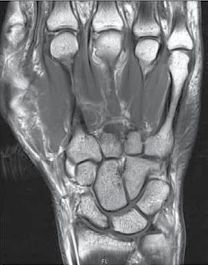 a b d Abb. 1 3-Tesla-Hochfeld MRT der rechten Hand eines 19-jährigen Patienten mit früher seropositiver RA (Krankheitsdauer 6 Woche). a T1-Sequenz mit Kontrastmittel (KM), coronare Schnittführung.