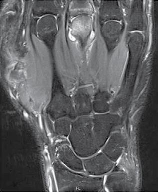 d vergrößerte Darstellung der Synovialitis mit Nachweis eines begleitenden Knochenmarködem (MCP-3) mehr als bedside imaging Verfahren die rechte Hand des Rheumatologen darstellt, ist auch die