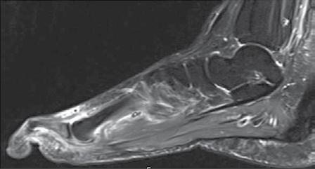 a b Abb. 2 3-Tesla-Hochfeld MRT des rechten Fußes einer 39-jährigen Patientin mit Psoriasis-Arthritis und klinischem Nachweis einer Daktylitis des II und III Strahles.
