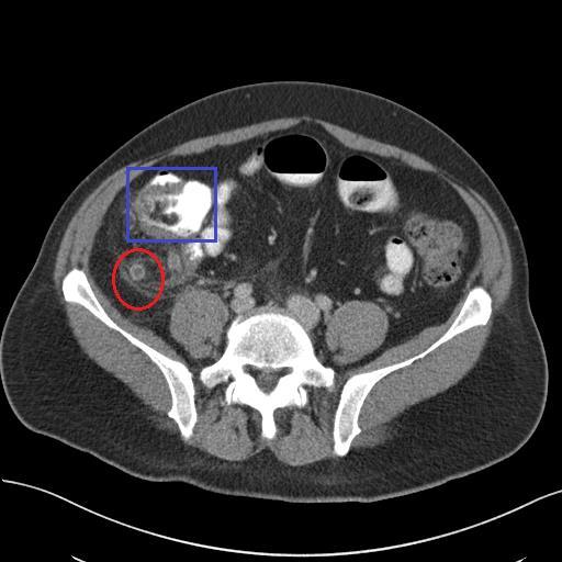 Abbildung 3.1: CT Abdomen eines 52- jährigen Patienten; Axiale Rekonstruktion. Bild einer akuten Appendizitis.