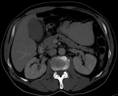 Abbildung 8.1: CT Abdomen eines 58- jährigen Patienten; Axiale Rekonstruktion.