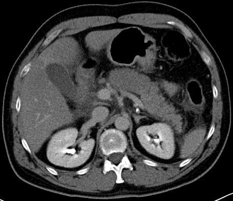 Abbildung 10.1: CT Abdomen eines 51- jährigen Patienten; Axiale Rekonstruktion.