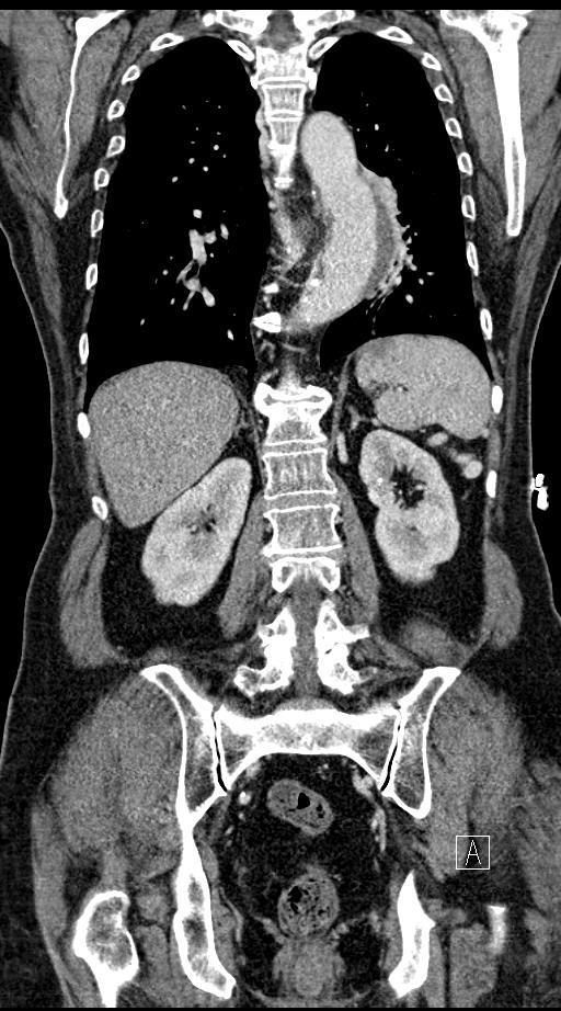 Abbildung 14.1: CT Stamm einer 68- jährige Patientin; Koronare Rekonstruktion.