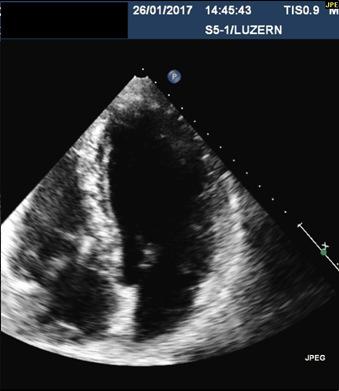 25 26 LVEF 25%, OMT