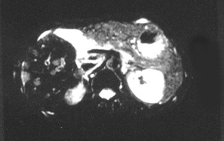 Bild 3 Bild 4 Fall 2: Hepatozelluläres Karzinom bei vorliegender Leberzirrhose Anamnese: Bei der 45 jährigen Patientin fallen sonographisch im Rahmen einer Kontrolluntersuchung bei bekannter