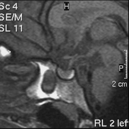 die Ursache der signalintensiven Darstellung der Neurohypophyse im T1-Bild bei 50-90% aller Untersuchungen ist kontrovers wahrscheinlich ADH-Komplex ein Fehlen ist kein Indikator für einen Diabetes