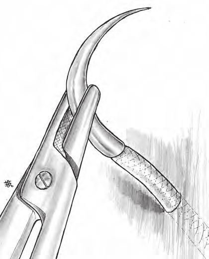der Nadel geschaffenen Stichkanal hinaus keine Verletzung des Gewebes Wundtrauma wird somit auf ein Minimum reduziert feste Verbindung zwischen Nadel und Faden, stufenloser Übergang zeitraubendes