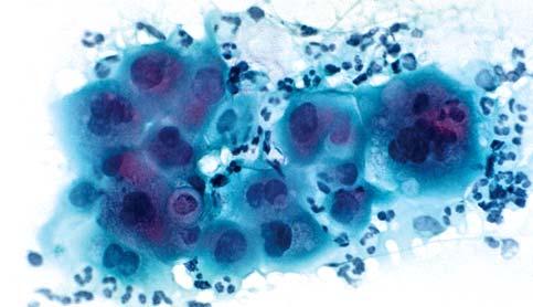 Differentialdiagnosen: Dysplasie Verhornendes invasives Karzinom Regenerationsepithel Herpes simplex genitalis Trichomoniasis/Soor Tab.