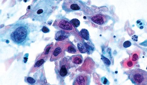Das verhornende, invasive Plattenepithelkarzinom der Zervix gibt sich meist durch das Vorliegen von reichlich atypischen Zellen mit ausgeprägter Polymorphie zu erkennen.