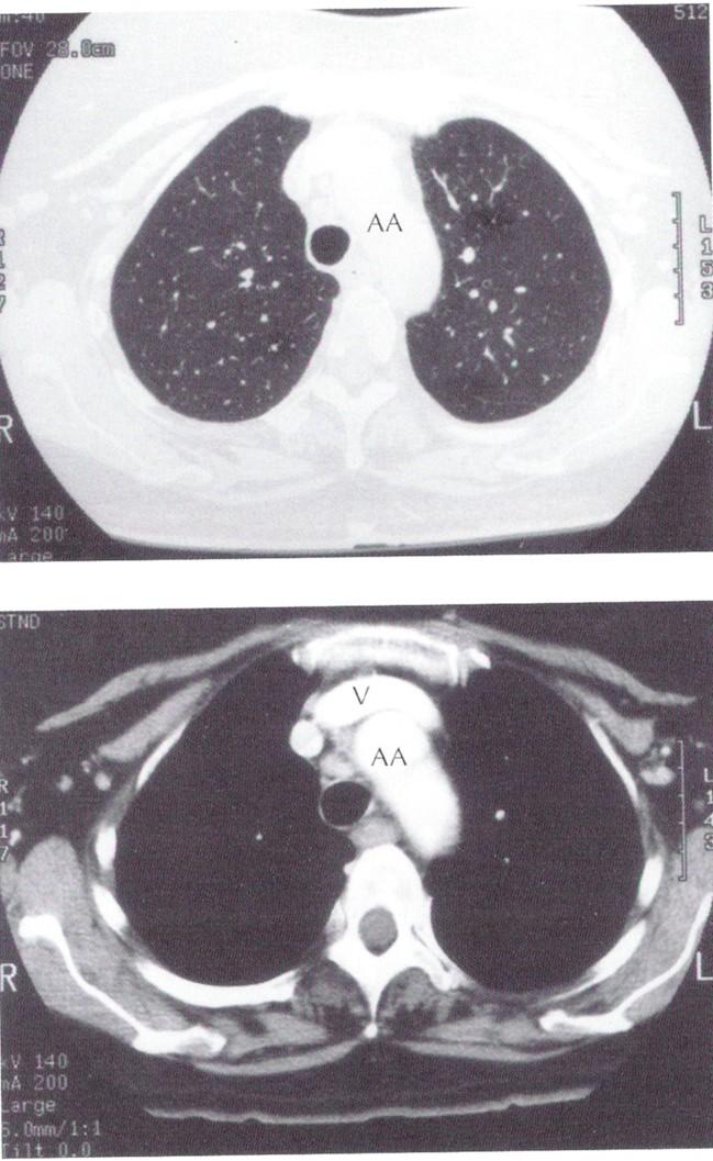 Computertomografie (CT) Lungenfenster Durch Wahl einer geeigneten sog.