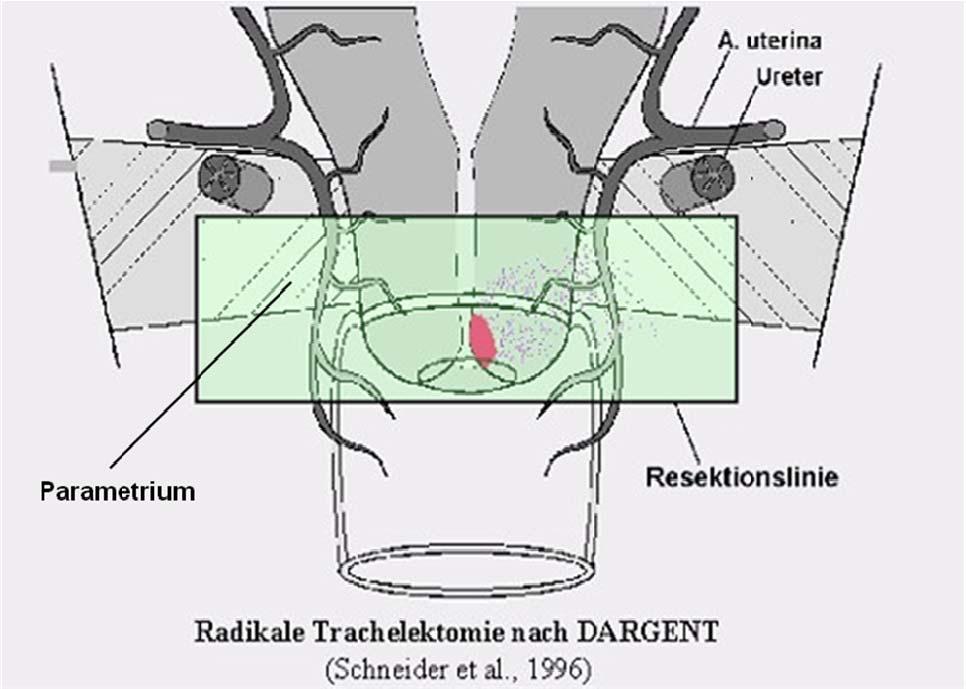 Seite 14 Abb. 3: Resektionslinien bei radikaler vaginaler Trachelektomie (RVT) Die RVT besteht aus zwei prinzipiell unterschiedlichen Abschnitten, dem laparoskopischen und dem vaginalen Teil.