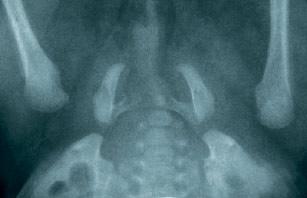 Das Nativröntgenbild Beckenübersicht und Hüftgelenk bds. axial ist zur Diagnosestellung ausreichend. Da beide Hüftgelenke betroffen sein können (ca.