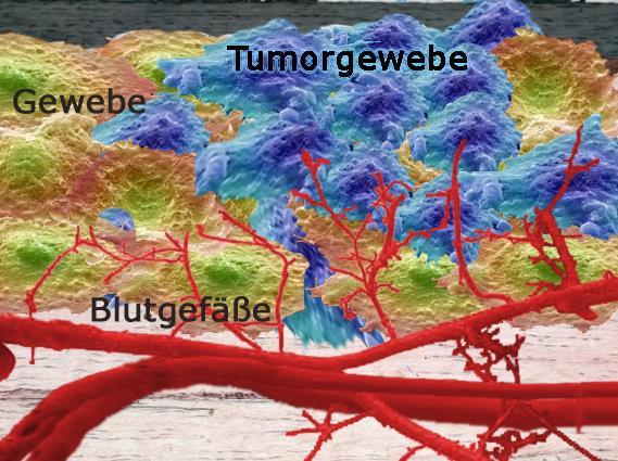 Abbildung 15: Tumorgewebe, das sich ausbreitet und Blutgefäße verschlingt Zusammengefasst kann man die Faktoren der Differenzierung zu Myofibroblasten also so zusammenfassen: Äußere motorische Reize