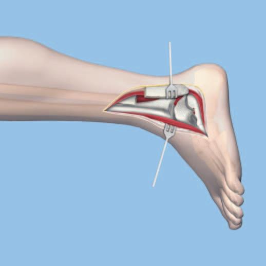 Rückfuss eröffnen 1 Fibulaosteotomie durchführen Eine Inzision lateral über der Fibula anlegen. Dissektion bis zum Knochen Richtung anterior.