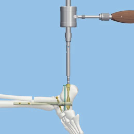 Implantatentfernung (optional) 1 Verschlussschraube entfernen Instrumente 03.010.109 Schraubenzieher Stardrive, T25, Länge 280 mm 311.