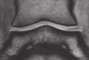 a MRT-Bilder des Hufgelenks in Tw GRE frontal von : Physiologische Darstellung MRI images of the distal interphalangeal joint in Tw GRE from grade : Physiological appearance Abb a MRT-Bilder der