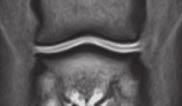 b MRT-Bilder des Hufgelenks in Tw GRE frontal von : Kleinere Unterbrechungen der Knorpellinie auf der linken Seite der Gelenkflächen mit geringem subchondralen Signalverlust MRI images of the distal