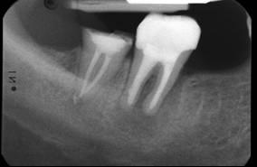 Dabei wurden 20 Zähne mit periapikalen Läsionen behandelt.