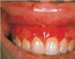Gingivitis / Parodontitis Akute oder chronische Entzündung des Zahnfleischsaumes / Zahnbettes; mechanisch, infektiös, toxisch oder hormonell bedingt.