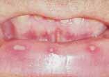 Mundschleimhautdefkte: Stomatitis / Stomatitis aphthosa Entzündliche Schleimhautveränderung im Mund multipler Genese, wie Druckstellen (z.b.