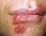 Herpes (Herpes simplex / Herpes labialis) Akute, primäre oder sekundäre Viruskrankheit der Haut und der Schleimhäute durch Infektion durch das Herpessimplex-Virus.
