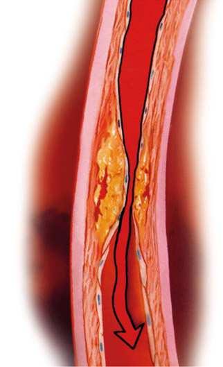 Die Koronare Herzerkrankung Starke Ablagerungen (verkalkt) Der Blutfluss ist teilweise unterbrochen.