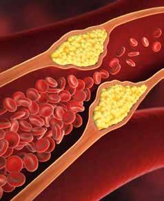 Die Folgen Bei Bluthochdruck verdicken sich die Wände der Gefäße durch Ablagerungen (z. B. Cholesterinplaques) und können im fortgeschrittenen Stadium die Blutbahn einengen.