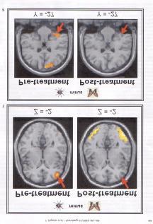 Paquette et al. (2003). Change the Mind and you change the Brain: Effects of Cognitive -Behavioral Therapy on the Neural Correlates of Spider Phobia. NeuroImage, 18, 401-409.